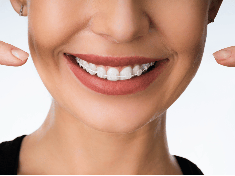 A woman's face with ceramic braces smiling